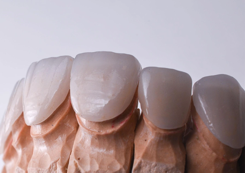 Kompozit Lamina vs. Porselen Lamina: Hangi Durumda Hangisi Tercih Edilmeli?