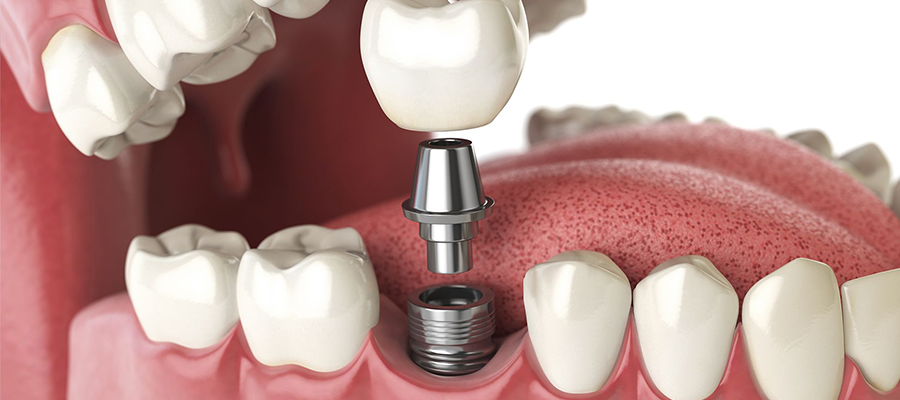 Nord Dental Clinic İzmir İmplant Tedavisi
