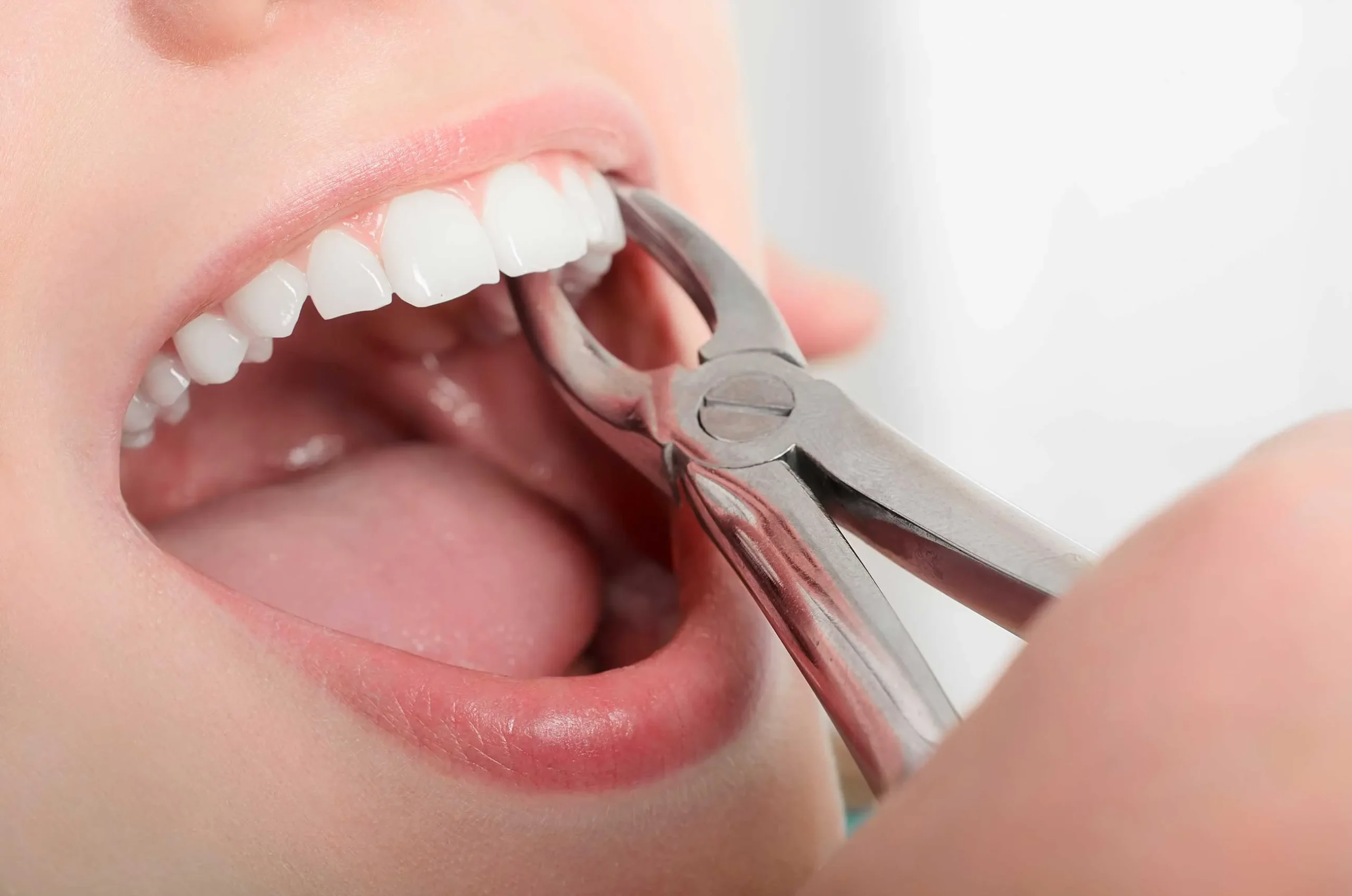 Nord Dental Clinic İzmir Diş Çekimi