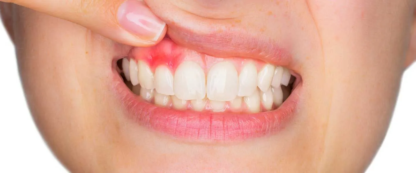 Nord Dental Clinic İzmir Diş Eti Hastalıkları