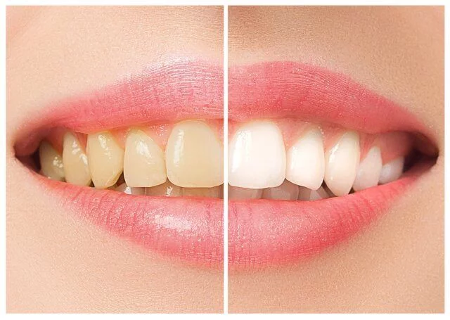 Nord Dental Clinic İzmir Diş Beyazlatma
