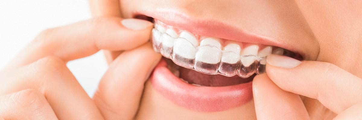 Nord Dental Clinic İzmir Şeffaf Plak Tedavisi